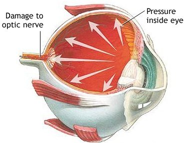 glaucoma visual loss