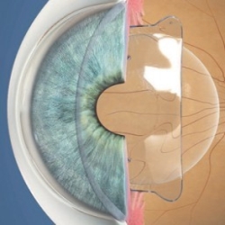 implantable collmer lens