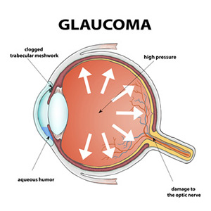glaucoma visual loss