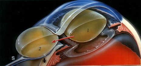 manual cataract surgery, sics