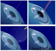 LASIK Surgery