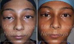 Ptosis