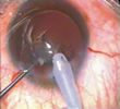 phacoemulsification surgery