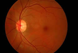 normal retina