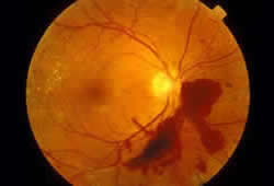 proliferative diabetic retinopathy