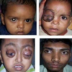 pediatric eye diseases