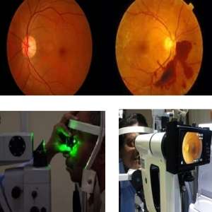 retina diseases